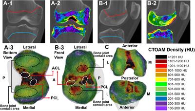 Variation characteristics of stress distribution in the subchondral bone of the knee joint of judo athletes with long-term stress changes